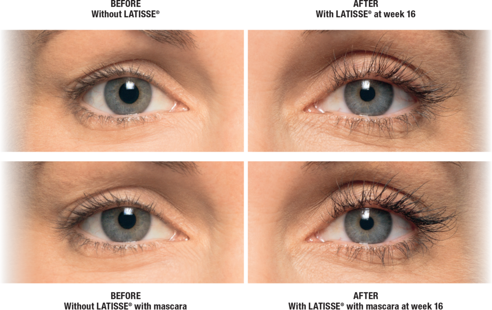 Latisse Before and After