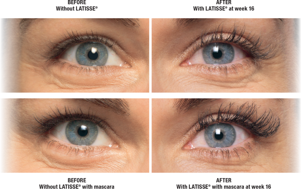 Latisse Before and After