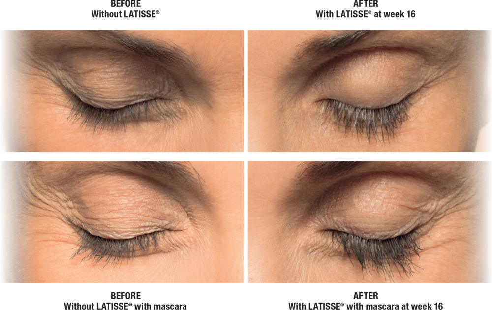 Latisse Before and After