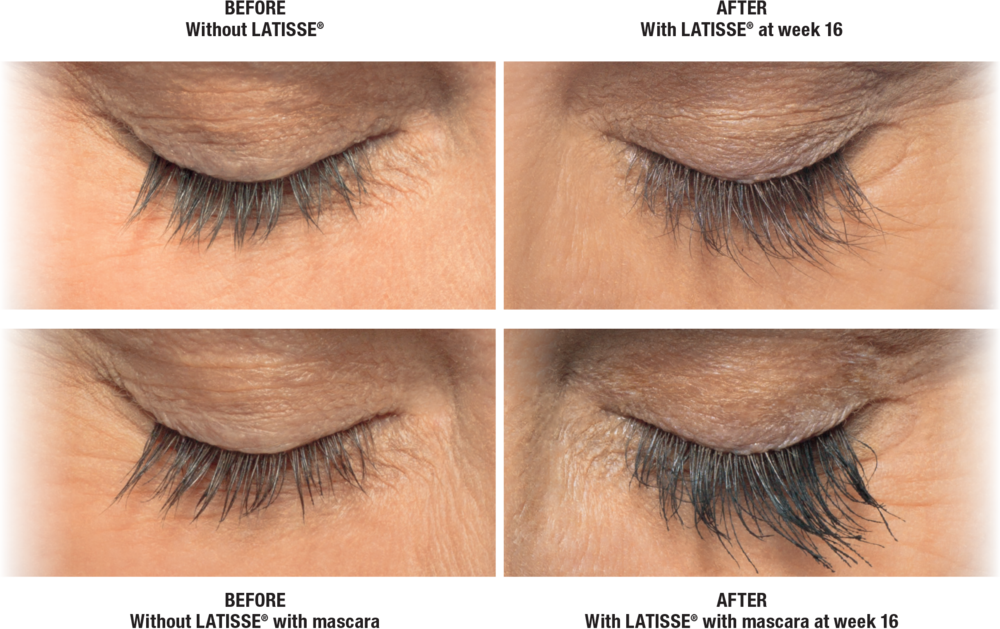 Latisse Before and After