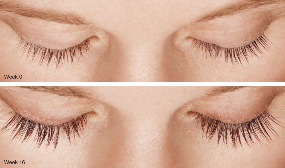 Latisse Before and After