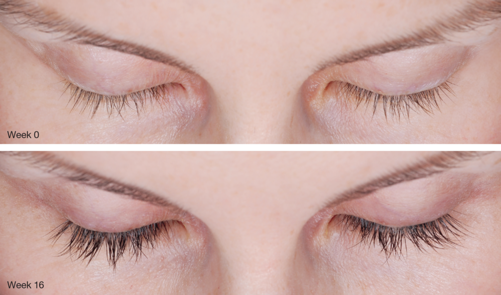 Latisse Before and After