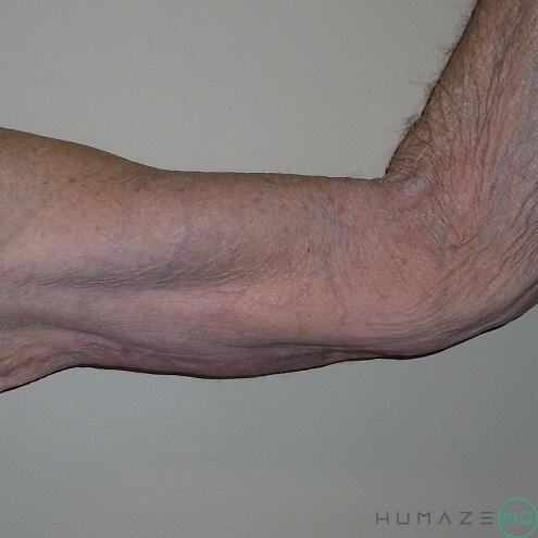 Arm Lift Before & After Image