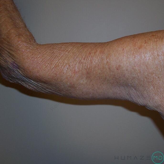 Arm Lift Before & After Image