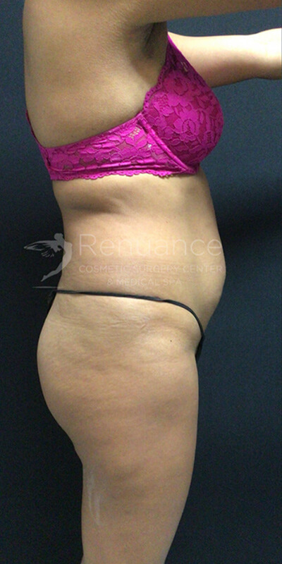 Brazilian Butt Lift Before & After Image