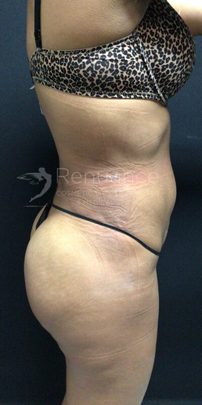 Brazilian Butt Lift Before & After Image