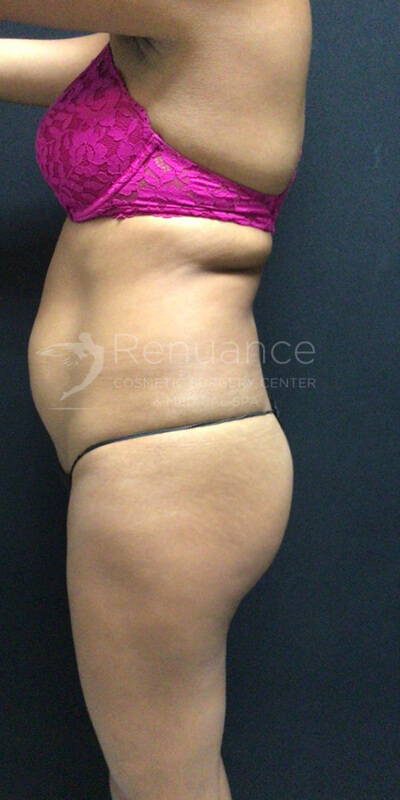 Brazilian Butt Lift Before & After Image