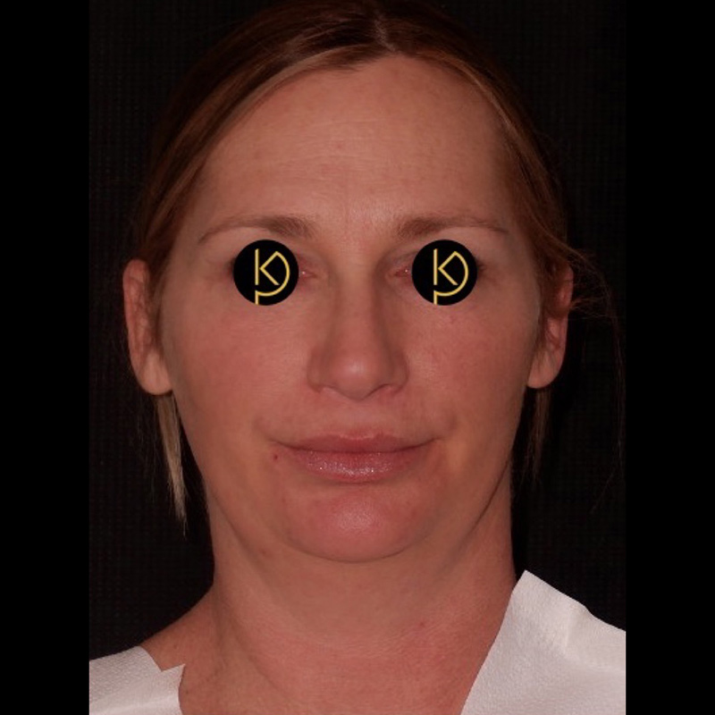 Liposuction Before & After Image