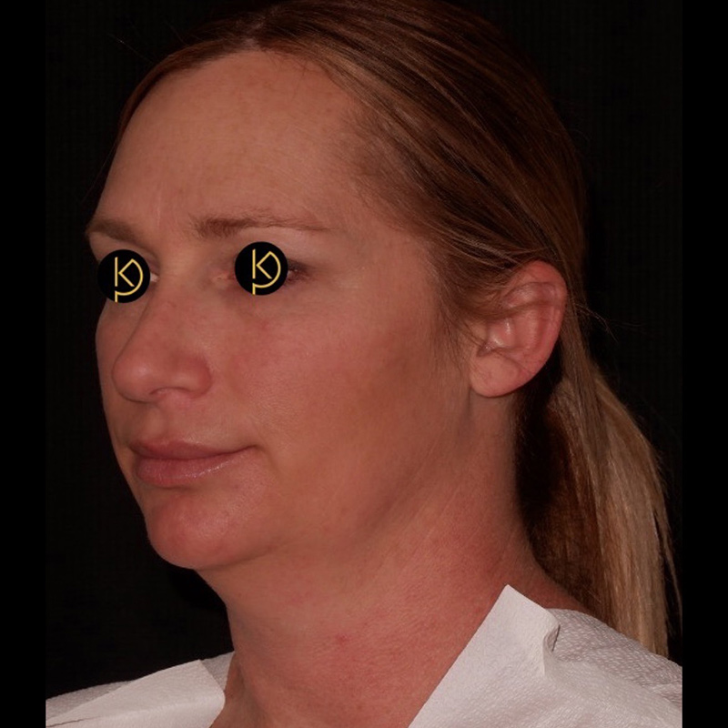 Liposuction Before & After Image