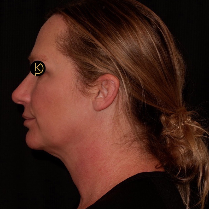 Liposuction Before & After Image