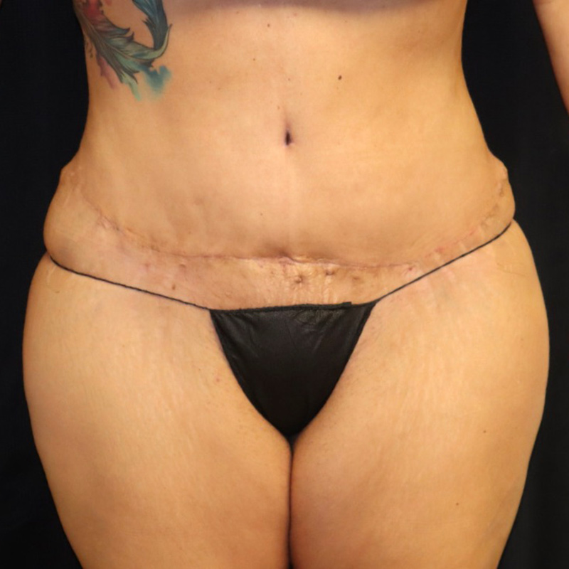 Liposuction Before & After Image