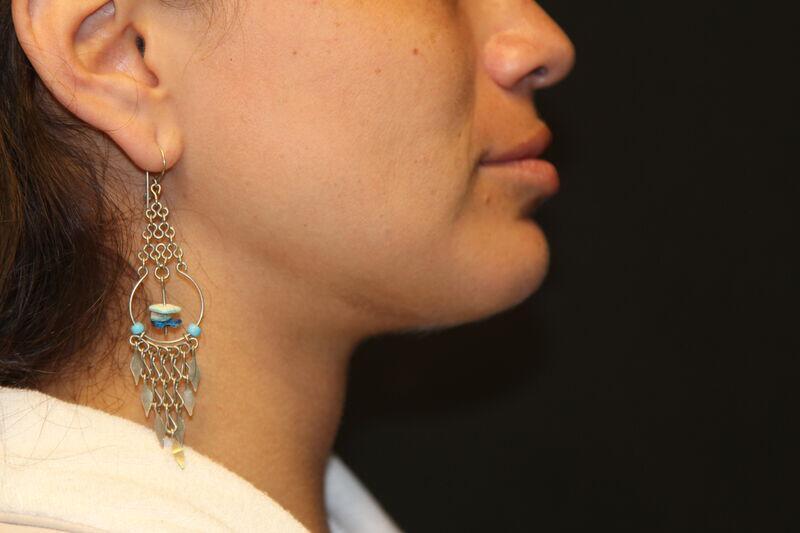 Liposuction Before & After Image