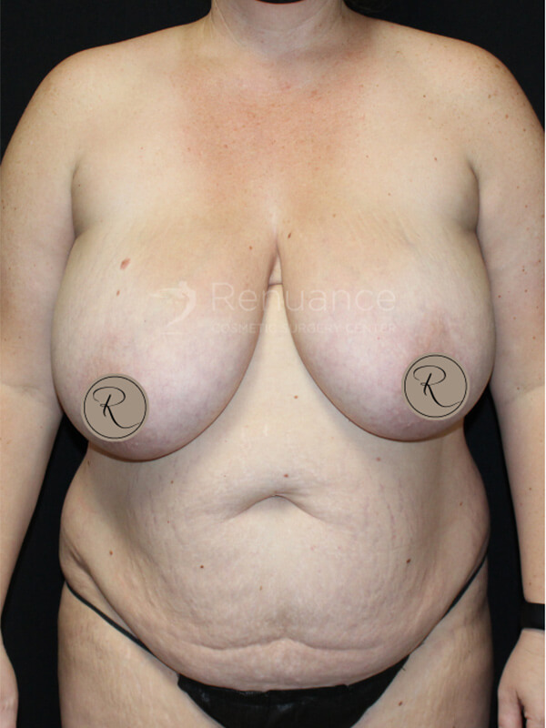 Mommy Makeover Before & After Image