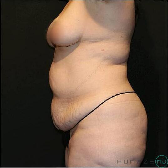 Mommy makeover Before & After Image