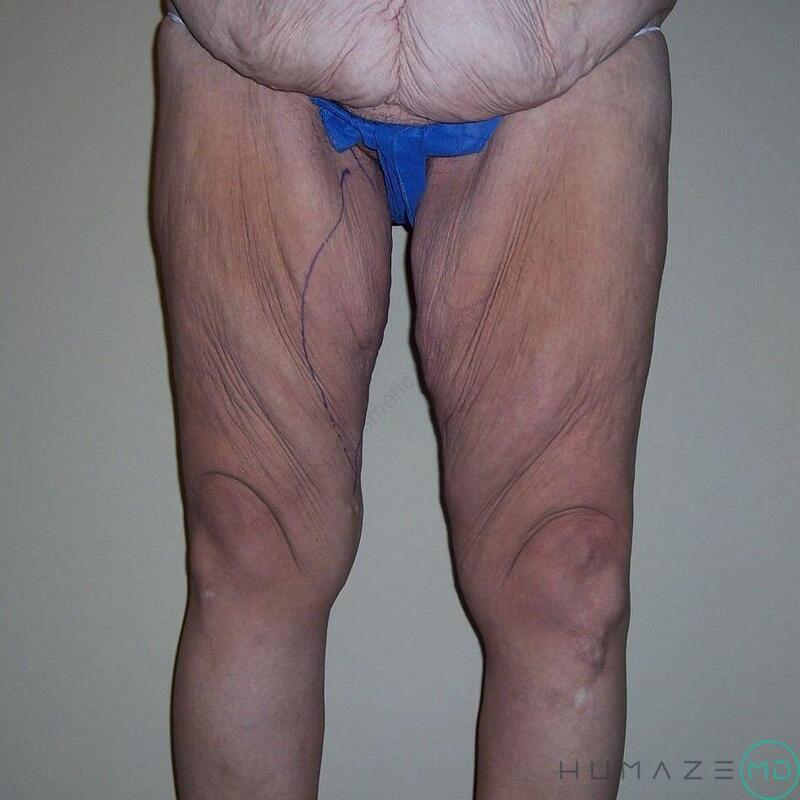 Thigh Lift Before & After Image