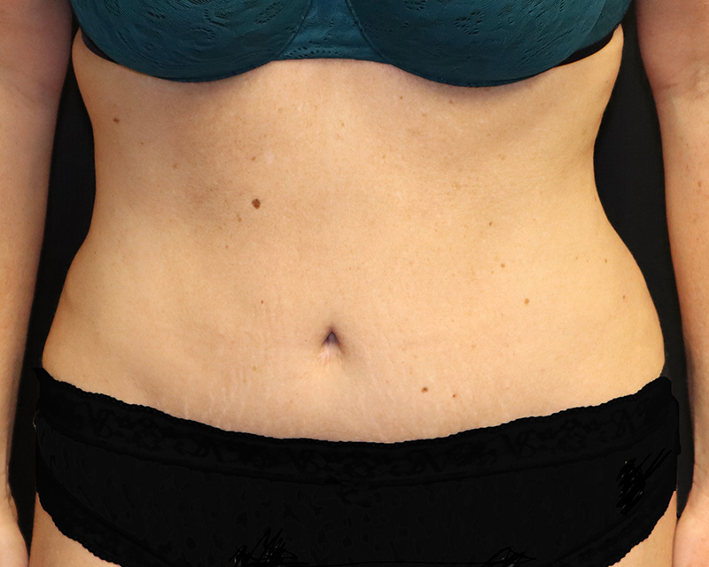 Tummy Tuck Before & After Image