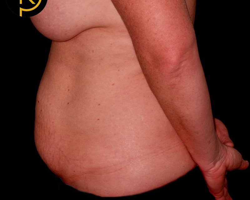 Tummy Tuck Before & After Image