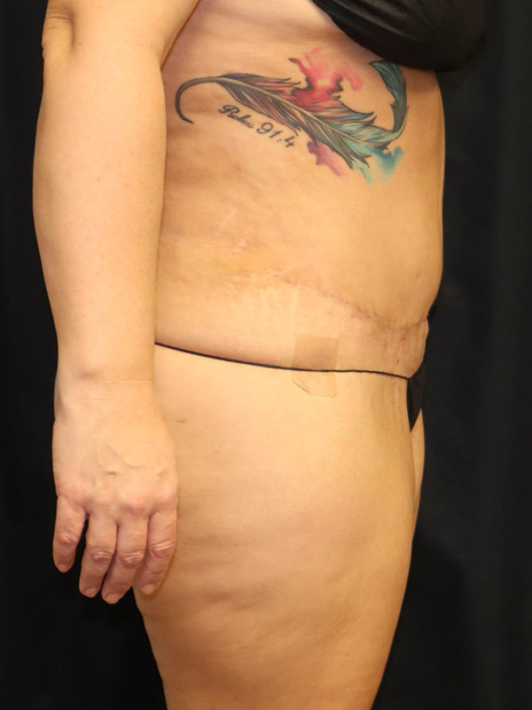 Tummy Tuck Before & After Image