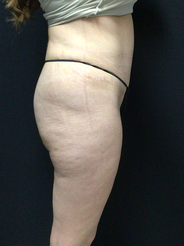 Tummy Tuck Before & After Image