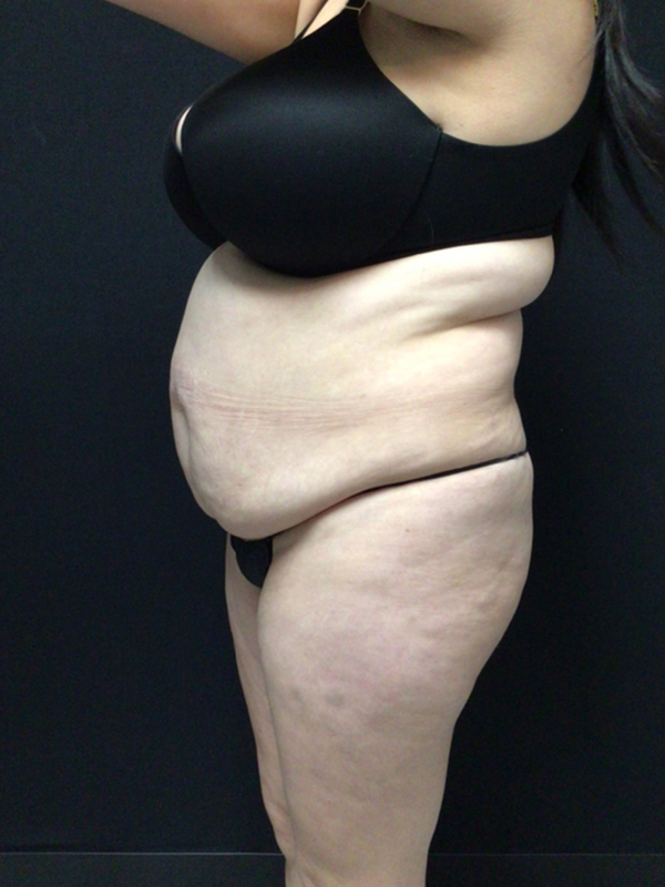 Tummy Tuck Before & After Image