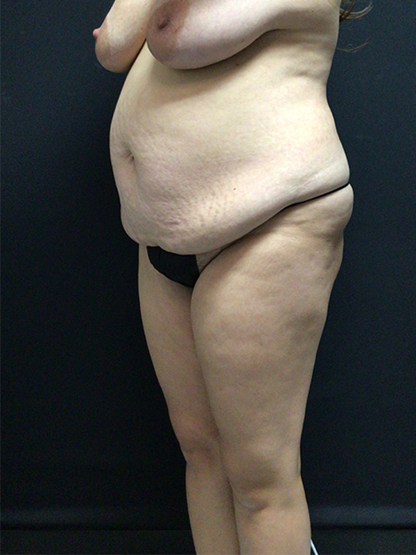 Tummy Tuck Before & After Image