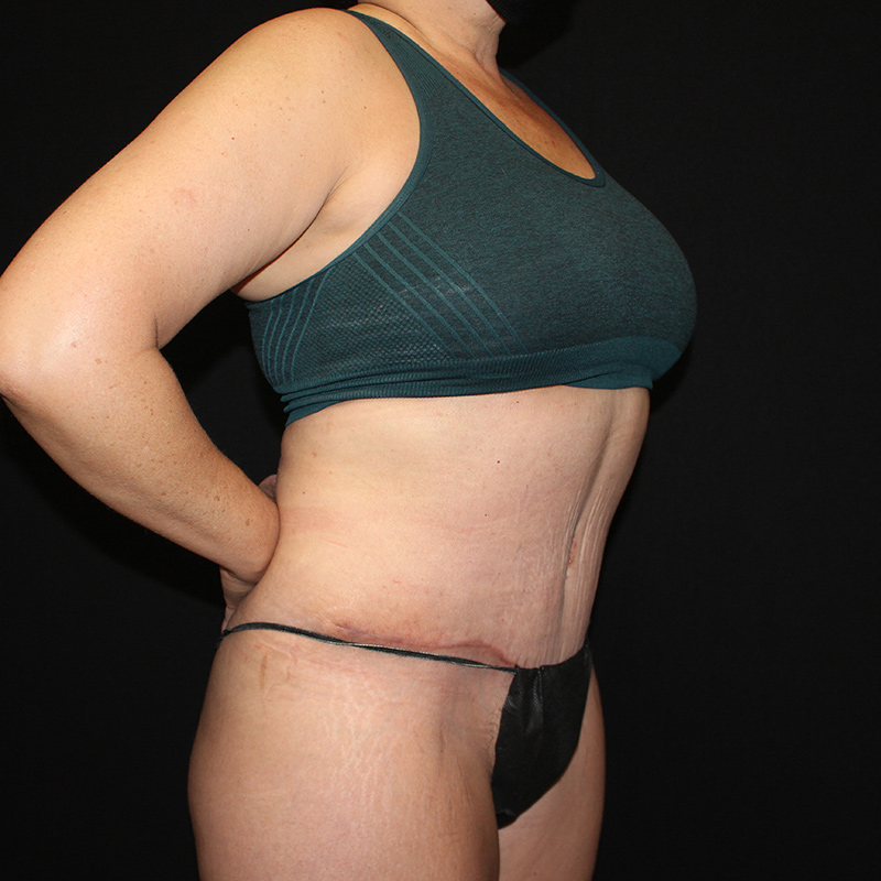 Tummy tuck Before & After Image