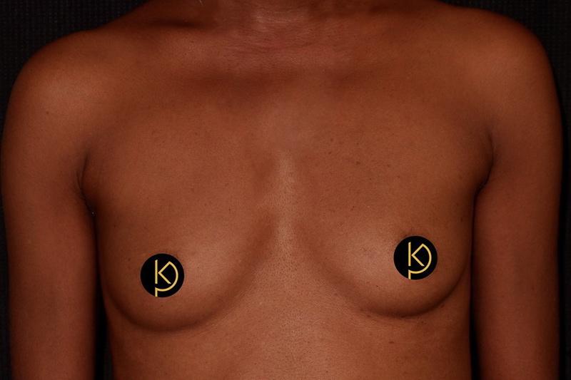 Breast Augmentation Before & After Image