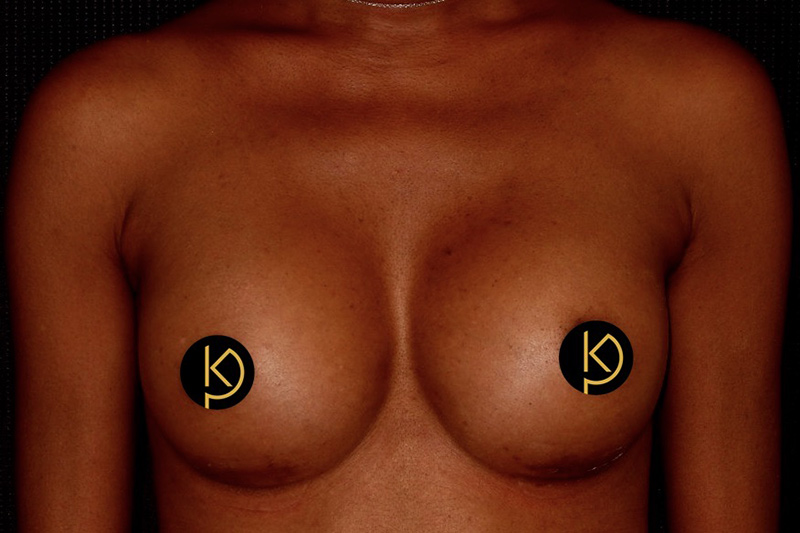 Breast Augmentation Before & After Image