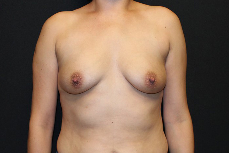 Breast Augmentation Before & After Image