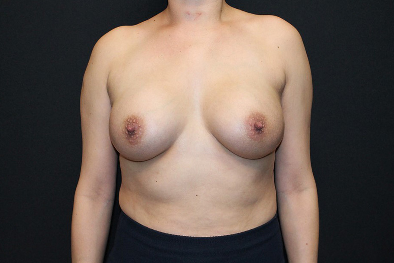 Breast Augmentation Before & After Image