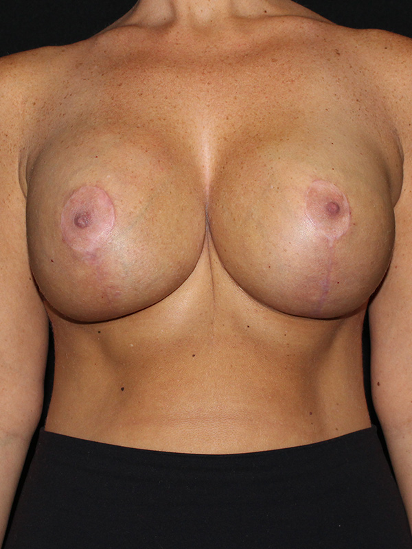 Breast Implant Exchange Before & After Image