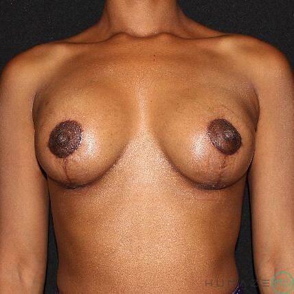 Breast Lift with Implants Before & After Image
