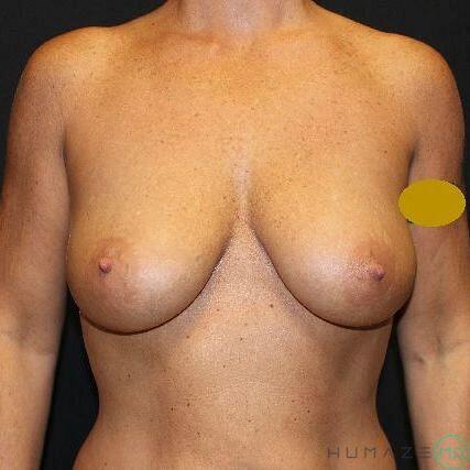 Breast Lift with Implants Before & After Image