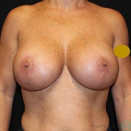 Breast Lift with Implants Before & After Image