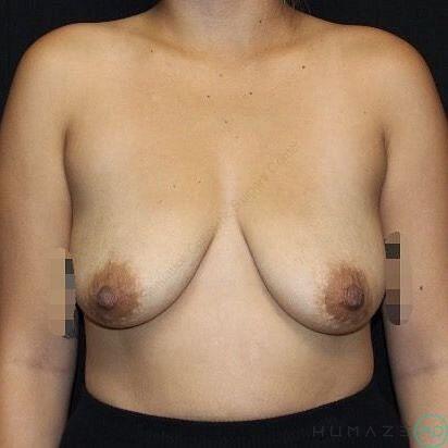 Breast Lift with Implants Before & After Image