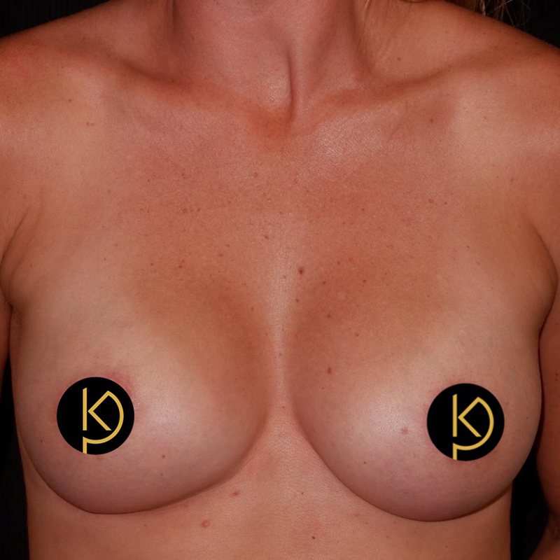 Breast Lift Before & After Image