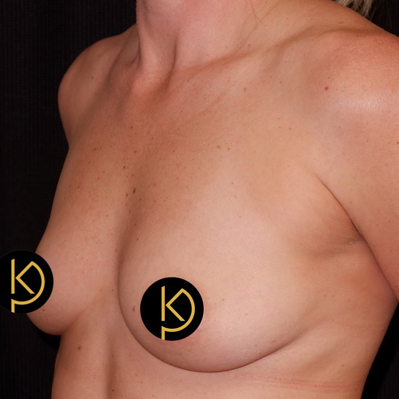 Breast Lift Before & After Image