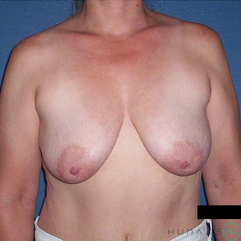 Breast lift Before & After Image