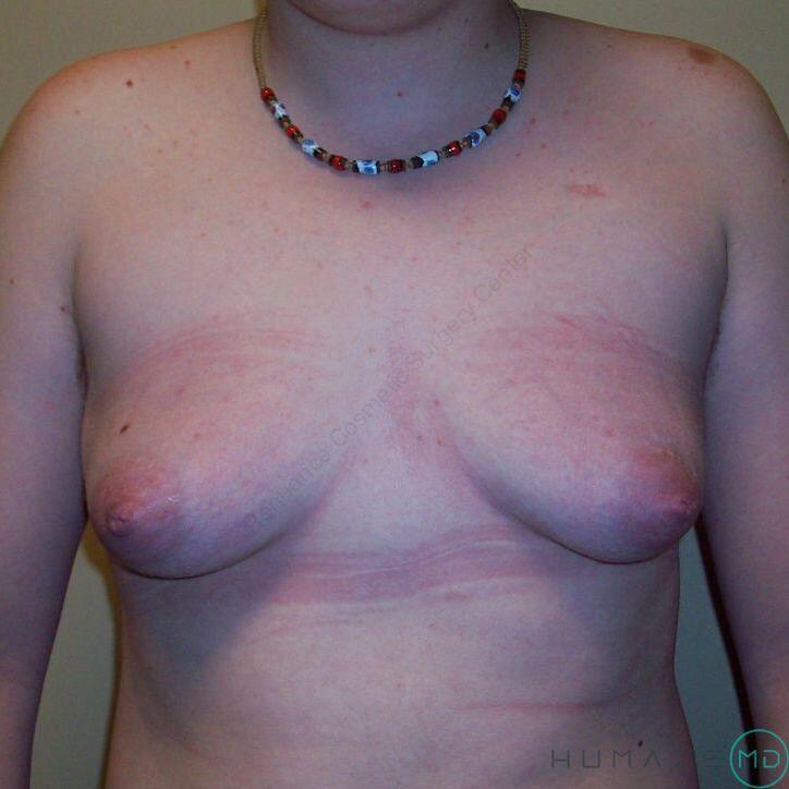 FTM Chest Masculinization Before & After Image