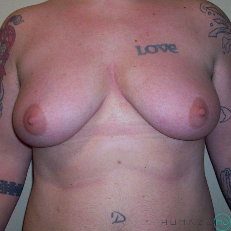 FTM Chest Masculinization Before & After Image