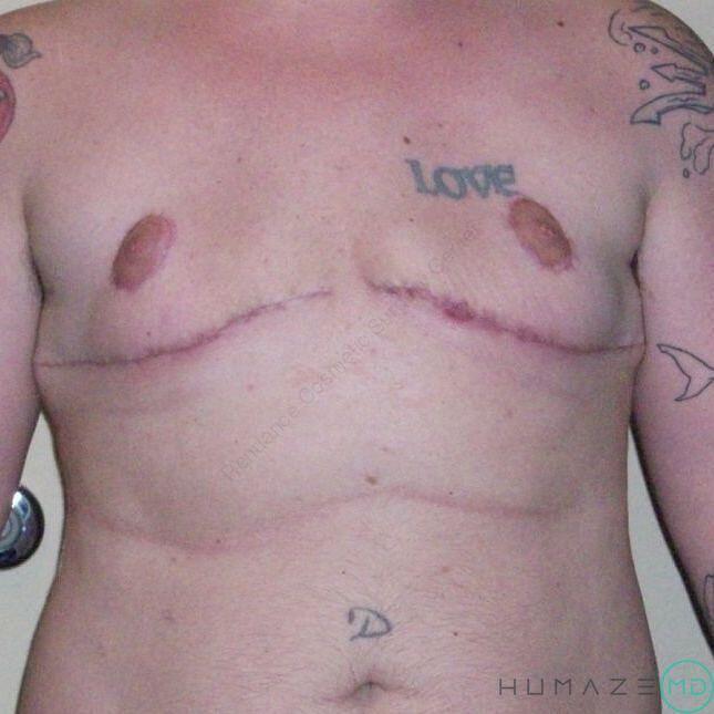 FTM Chest Masculinization Before & After Image