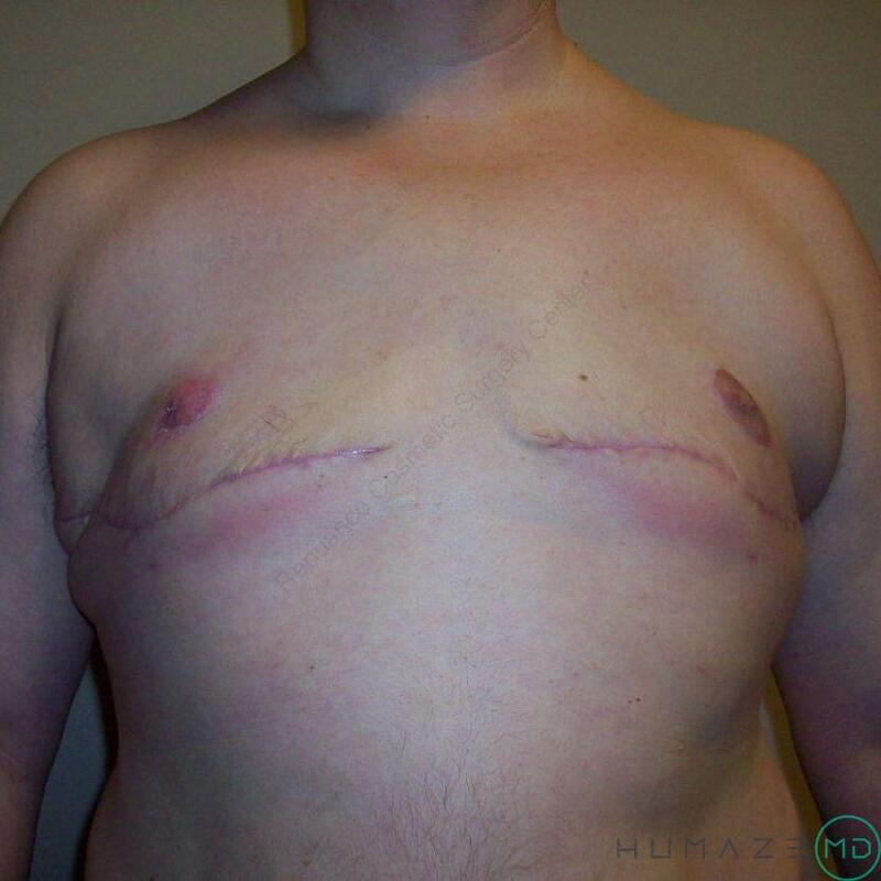 FTM Chest Masculinization Before & After Image