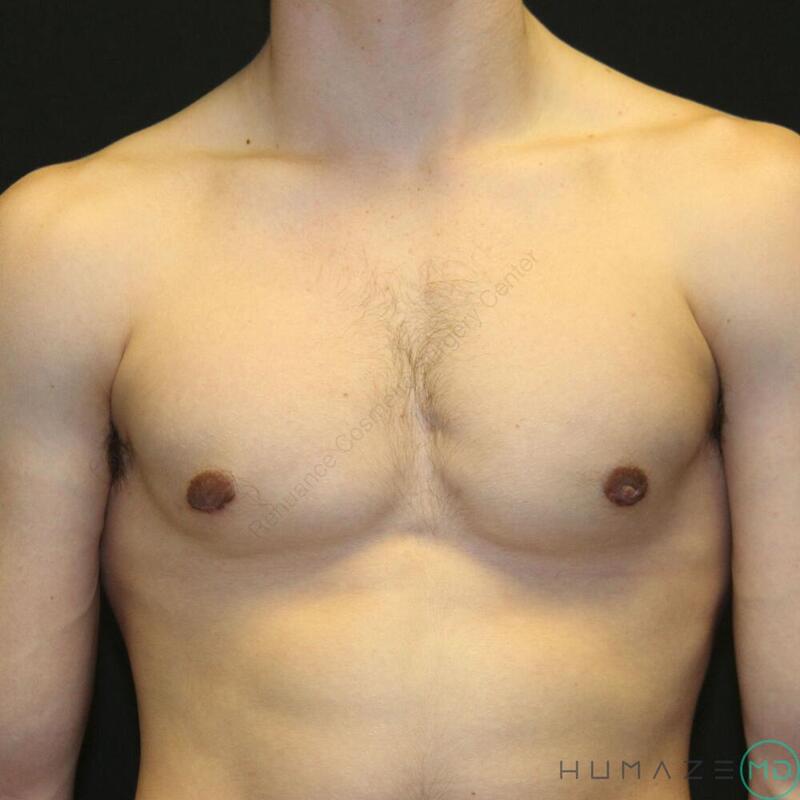 Gynecomastia Surgery Before & After Image