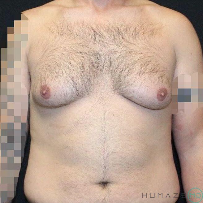 Gynecomastia Surgery Before & After Image