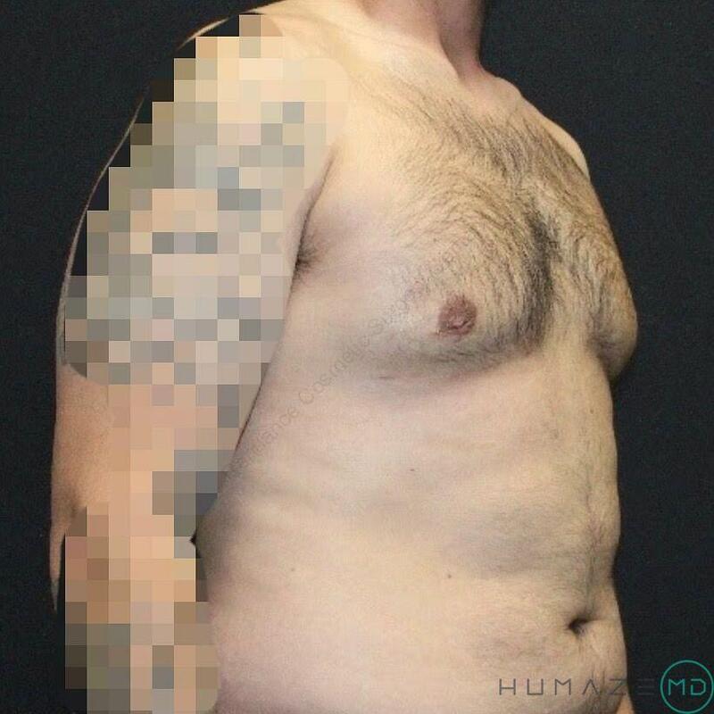 Gynecomastia Surgery Before & After Image