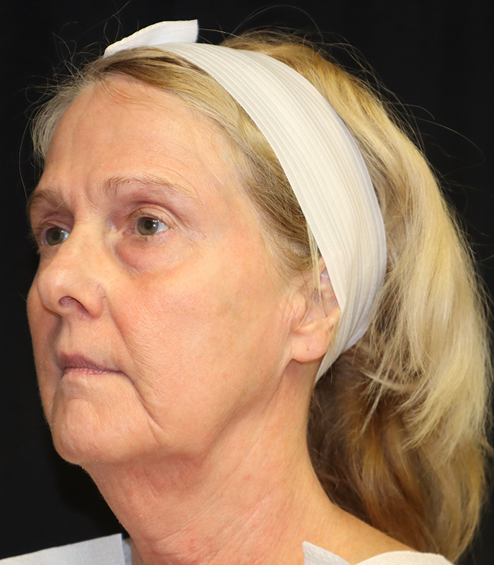 Blepharoplasty Before & After Image