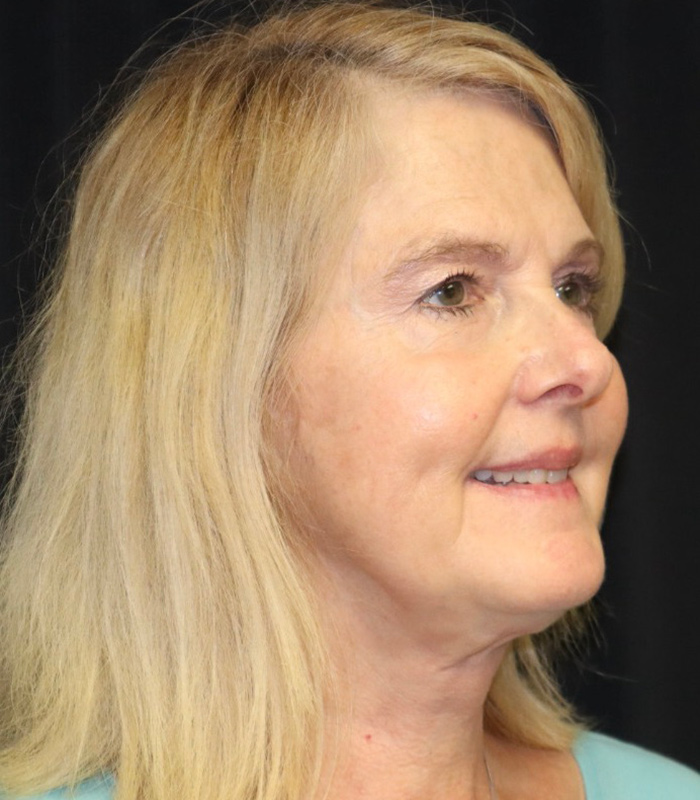 Blepharoplasty Before & After Image