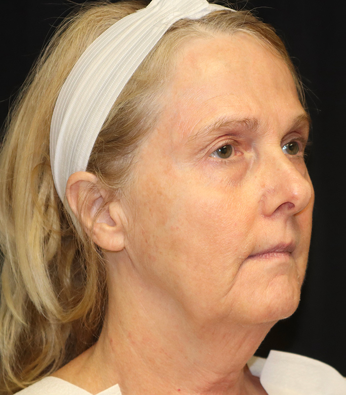 Blepharoplasty Before & After Image