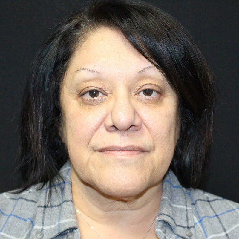 Blepharoplasty Before & After Image