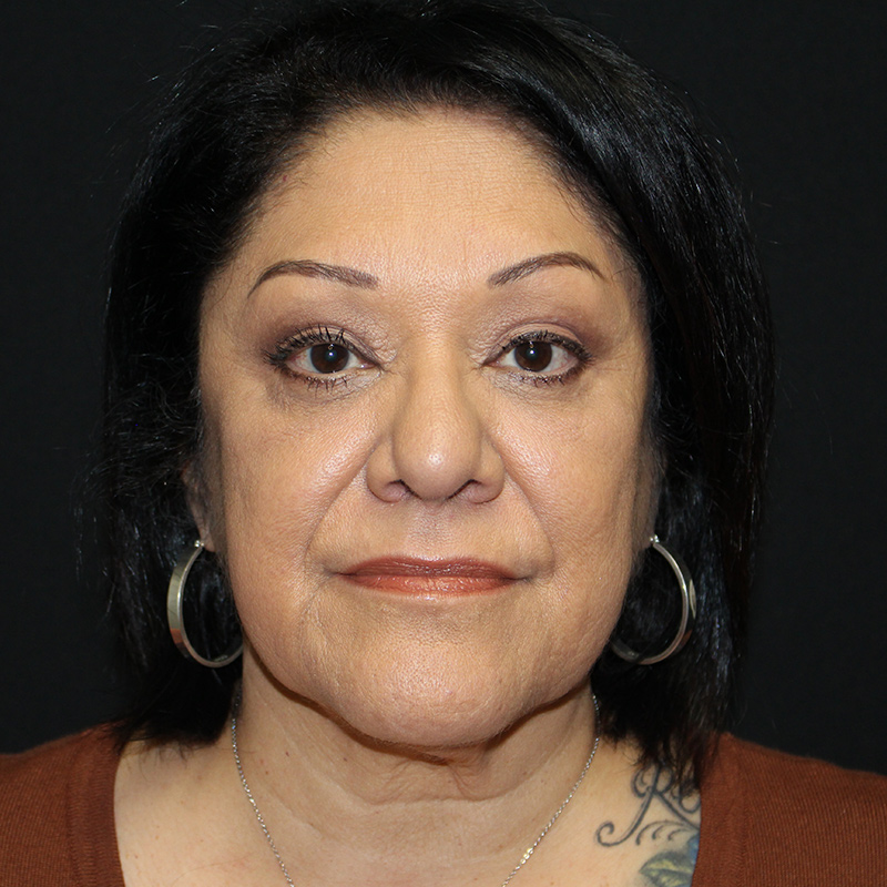 Blepharoplasty Before & After Image